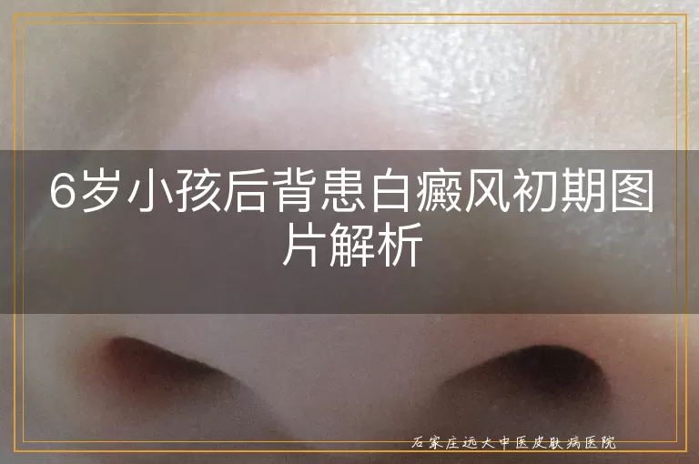6岁小孩后背患白癜风初期图片解析