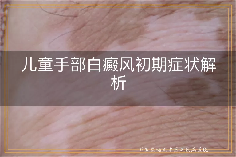 儿童手部白癜风初期症状解析
