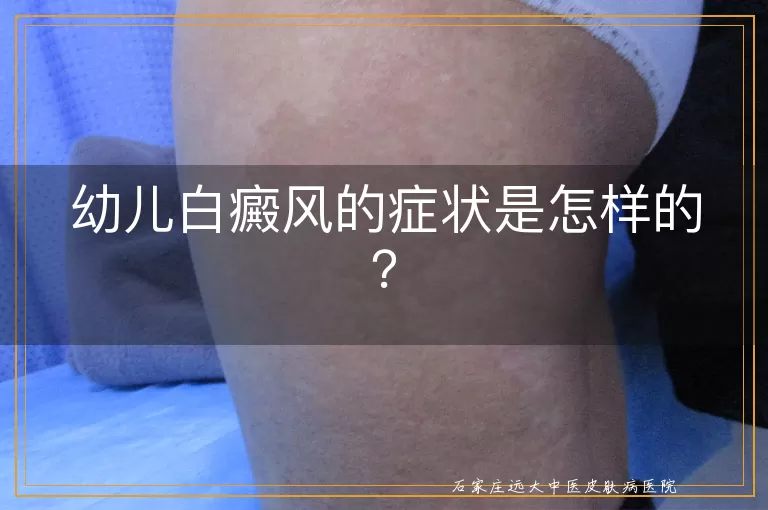 幼儿白癜风的症状是怎样的？