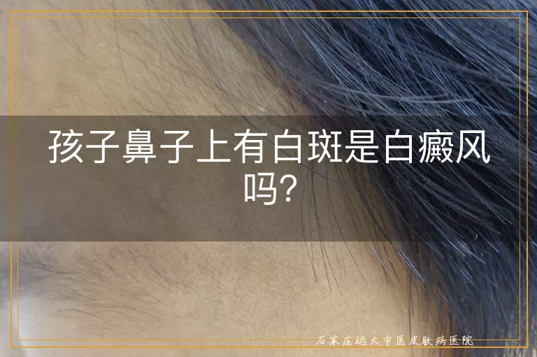 孩子鼻子上有白斑是白癜风吗？
