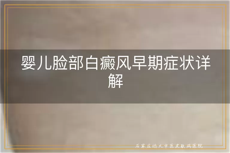 婴儿脸部白癜风早期症状详解