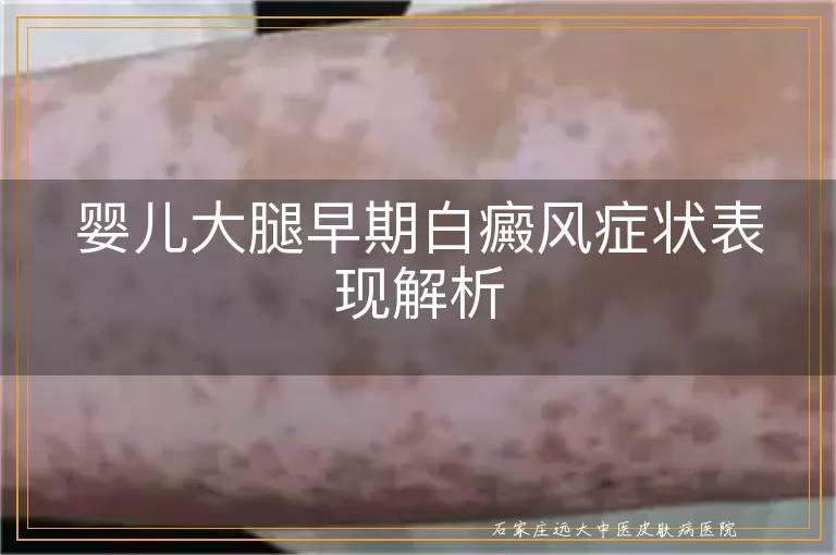 婴儿大腿早期白癜风症状表现解析