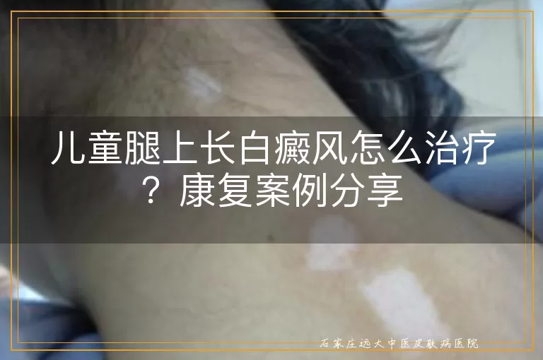 儿童腿上长白癜风怎么治疗？康复案例分享