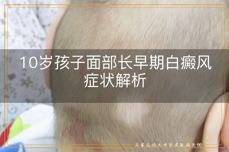 10岁孩子面部长早期白癜风症状解析