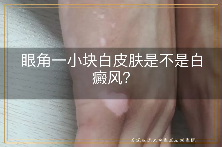 眼角一小块白皮肤是不是白癜风？