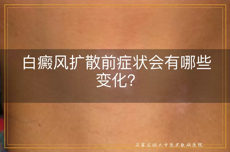白癜风扩散前症状会有哪些变化？