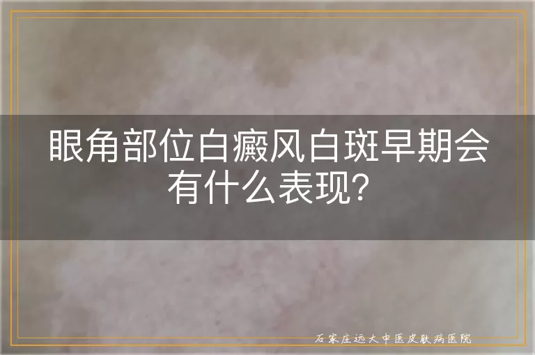 眼角部位白癜风白斑早期会有什么表现？