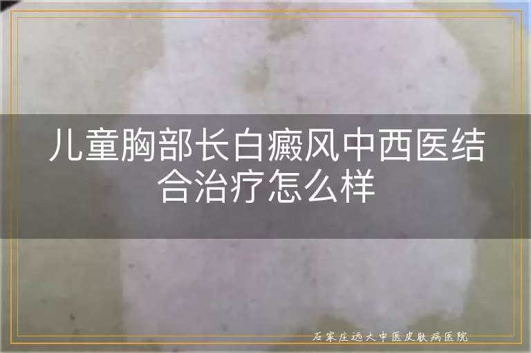 儿童胸部长白癜风中西医结合治疗怎么样