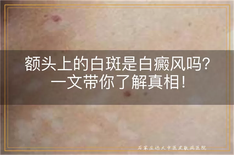 额头上的白斑是白癜风吗？一文带你了解真相！