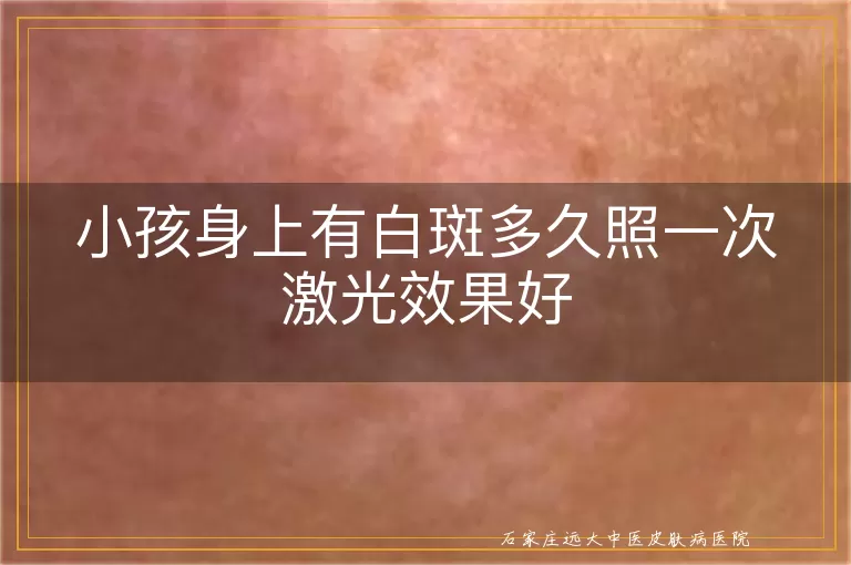 小孩身上有白斑多久照一次激光效果好