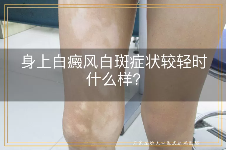 身上白癜风白斑症状较轻时什么样？