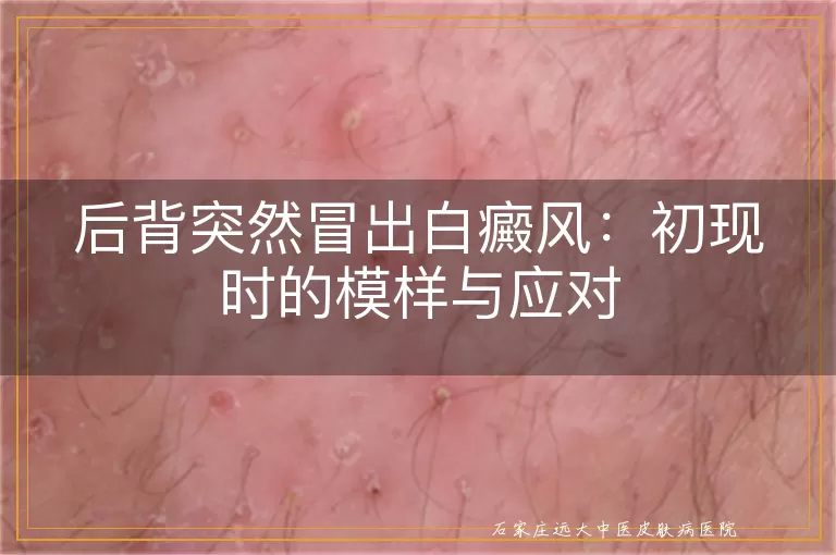 后背突然冒出白癜风：初现时的模样与应对