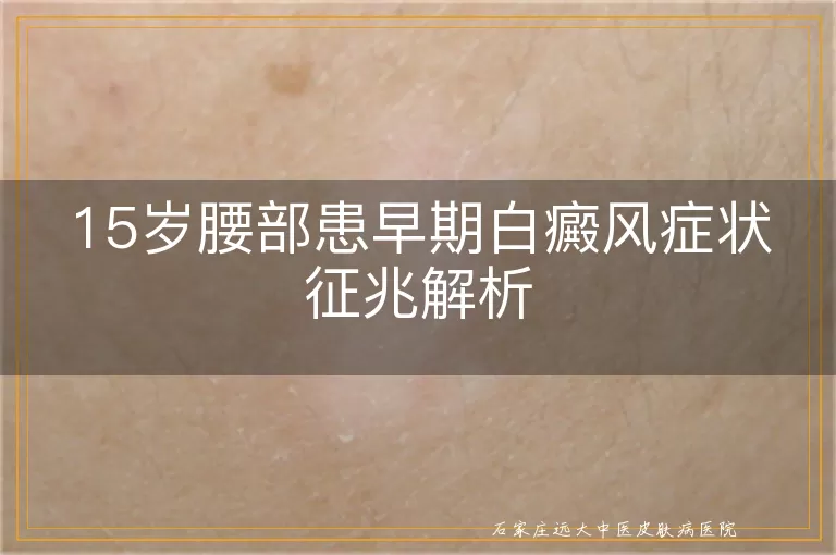 15岁腰部患早期白癜风症状征兆解析