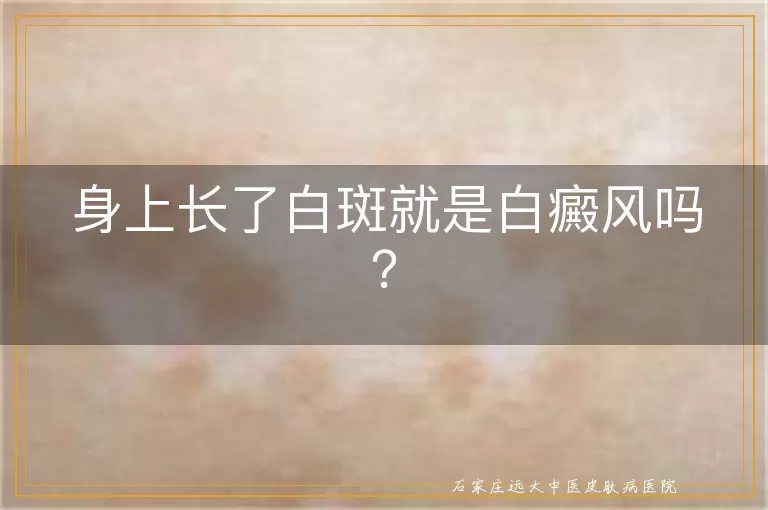 身上长了白斑就是白癜风吗？