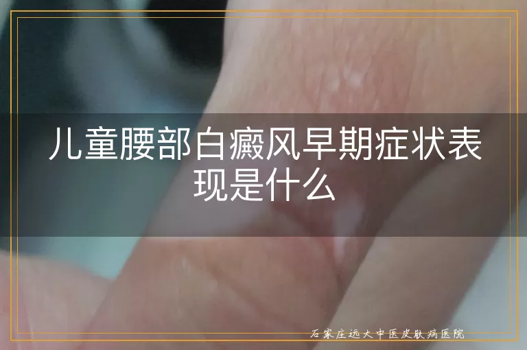 儿童腰部白癜风早期症状表现是什么