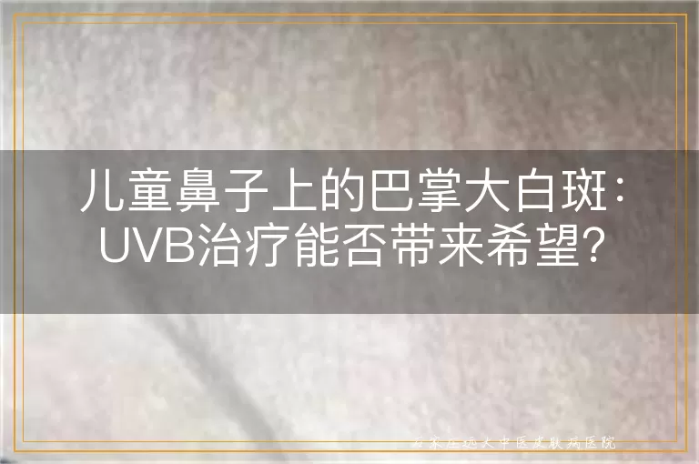 儿童鼻子上的巴掌大白斑：UVB治疗能否带来希望？