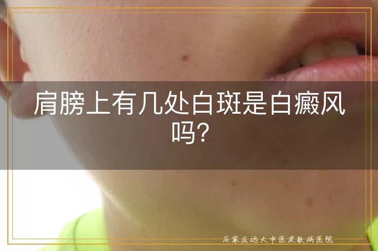 肩膀上有几处白斑是白癜风吗？