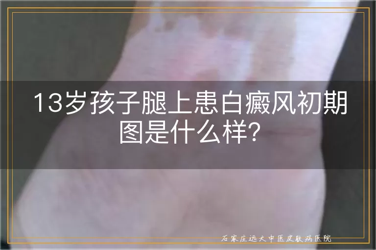 13岁孩子腿上患白癜风初期图是什么样？