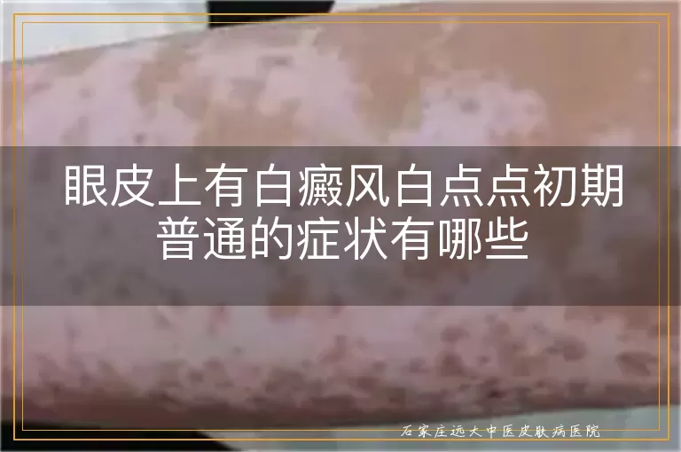 眼皮上有白癜风白点点初期普通的症状有哪些