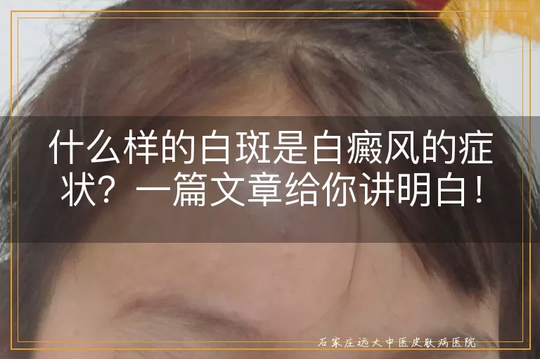 什么样的白斑是白癜风的症状？一篇文章给你讲明白！