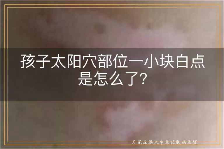 孩子太阳穴部位一小块白点是怎么了？