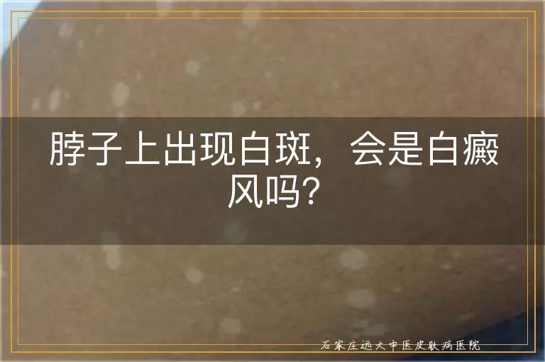 脖子上出现白斑，会是白癜风吗？