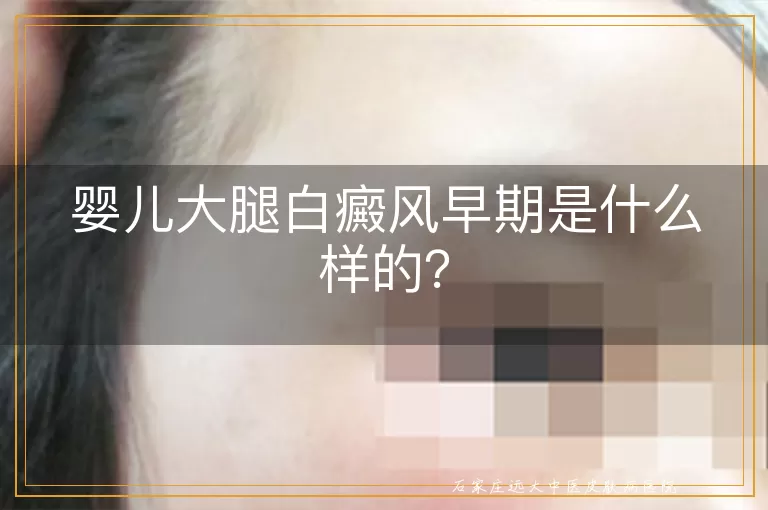 婴儿大腿白癜风早期是什么样的？