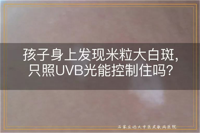 孩子身上发现米粒大白斑，只照UVB光能控制住吗？