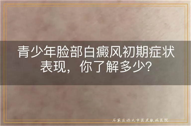 青少年脸部白癜风初期症状表现，你了解多少？
