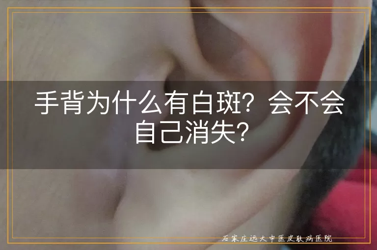 手背为什么有白斑？会不会自己消失？