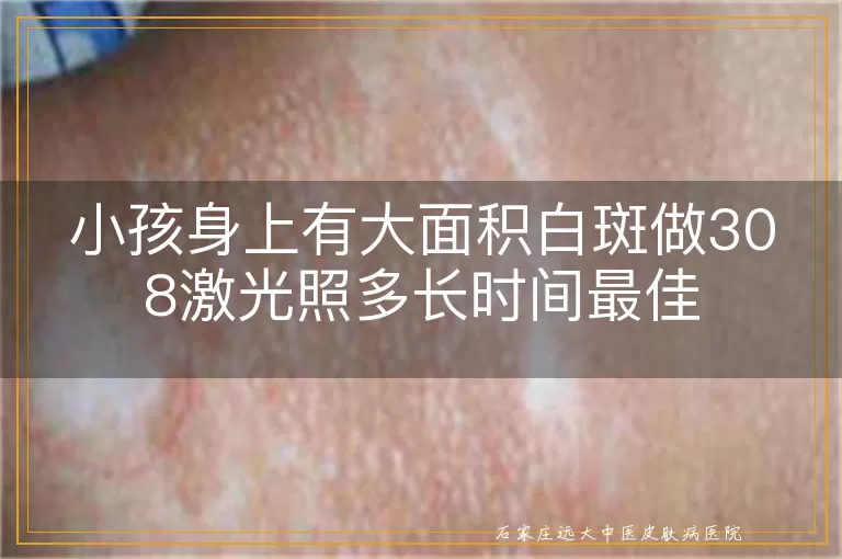 小孩身上有大面积白斑做308激光照多长时间最佳