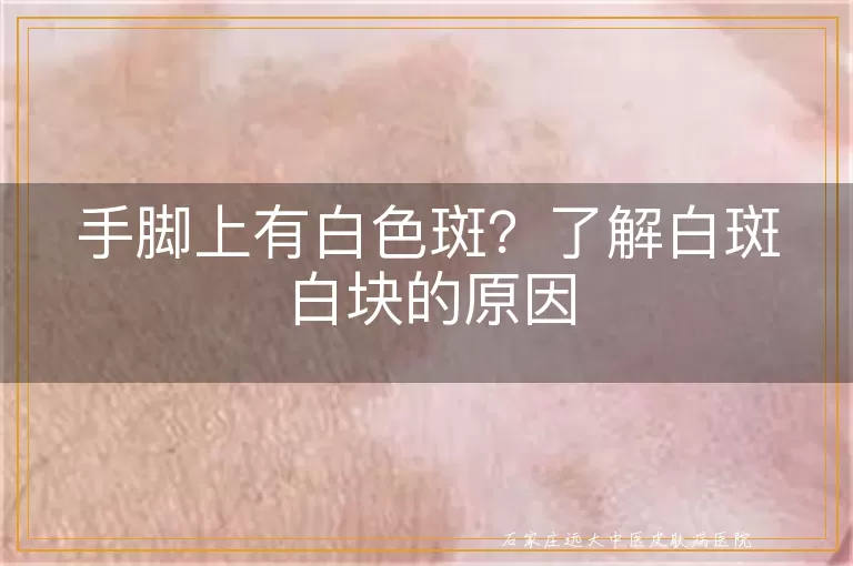 手脚上有白色斑？了解白斑白块的原因