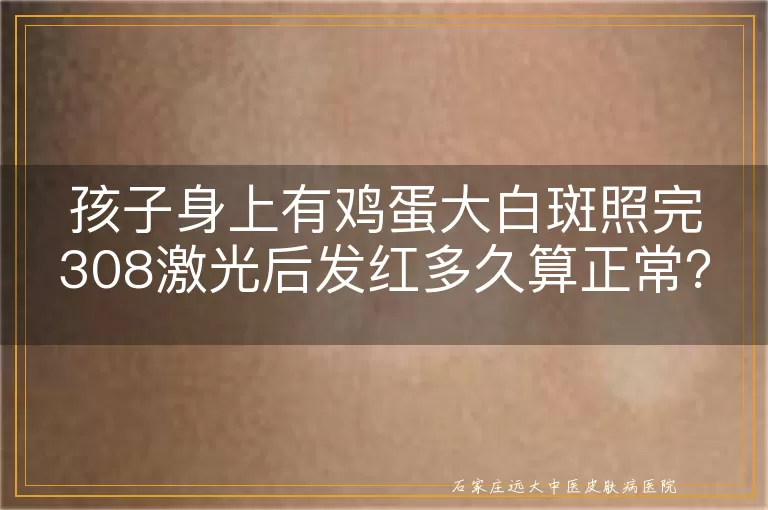 孩子身上有鸡蛋大白斑照完308激光后发红多久算正常？