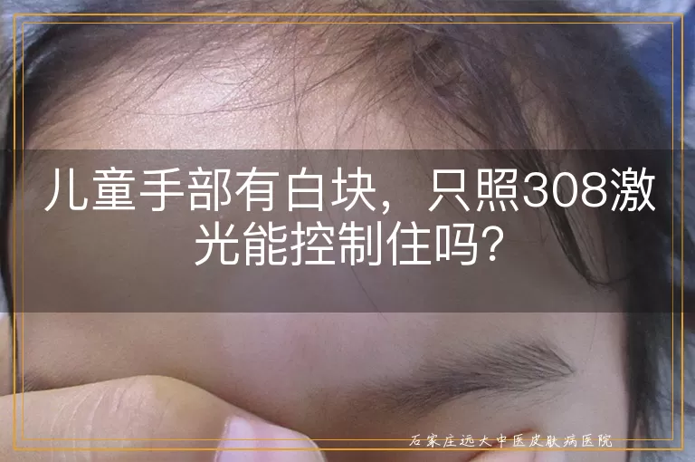 儿童手部有白块，只照308激光能控制住吗？