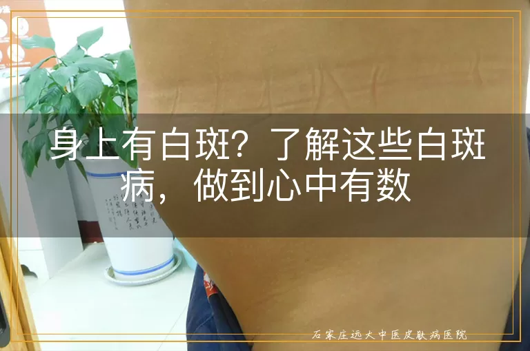 身上有白斑？了解这些白斑病，做到心中有数