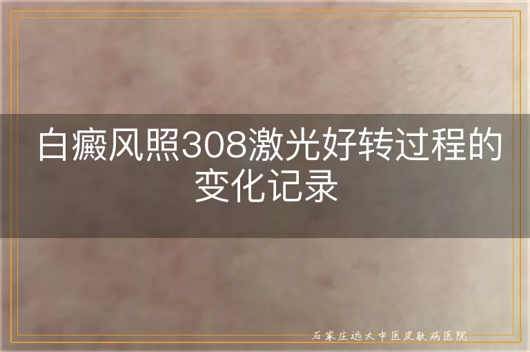 白癜风照308激光好转过程的变化记录