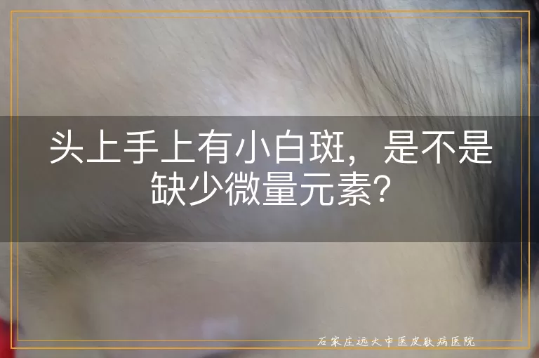 头上手上有小白斑，是不是缺少微量元素？