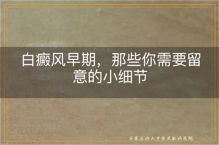 白癜风早期，那些你需要留意的小细节