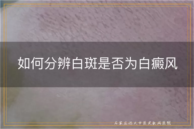 如何分辨白斑是否为白癜风