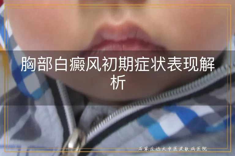 胸部白癜风初期症状表现解析