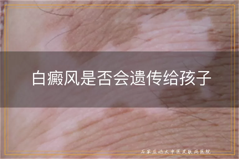 白癜风是否会遗传给孩子
