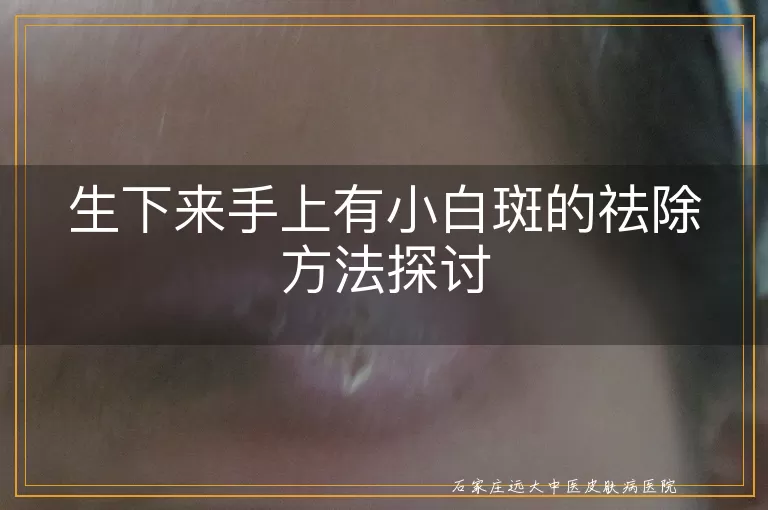 生下来手上有小白斑的祛除方法探讨