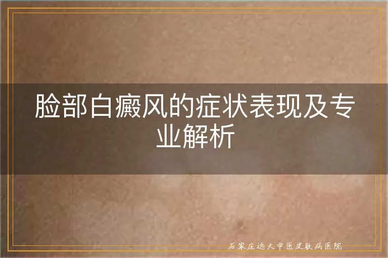 脸部白癜风的症状表现及专业解析