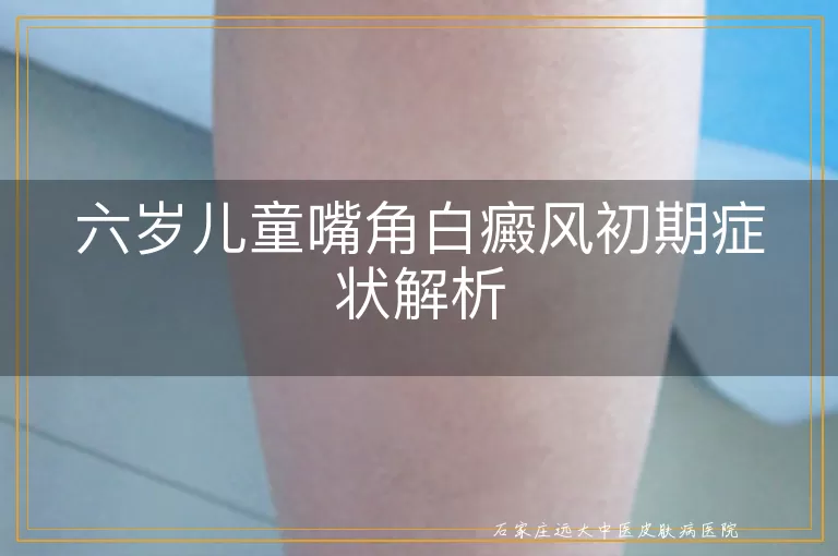 六岁儿童嘴角白癜风初期症状解析