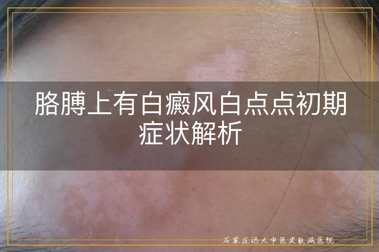 胳膊上有白癜风白点点初期症状解析