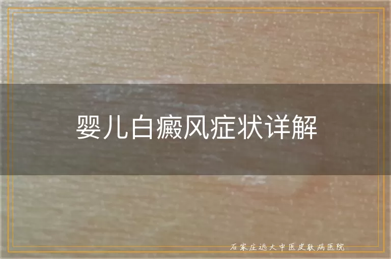 婴儿白癜风症状详解