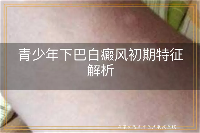 青少年下巴白癜风初期特征解析
