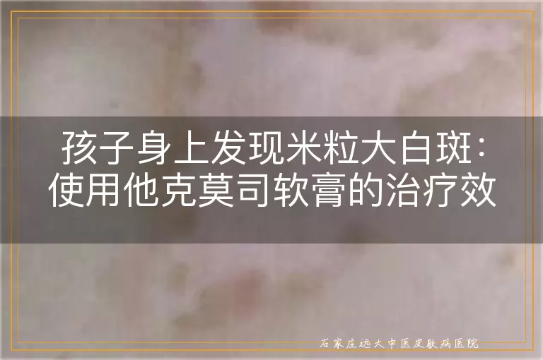 孩子身上发现米粒大白斑：使用他克莫司软膏的治疗效果与预期时间