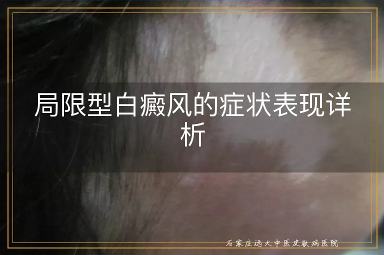局限型白癜风的症状表现详析