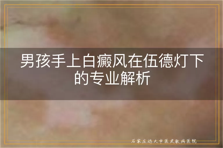 男孩手上白癜风在伍德灯下的专业解析